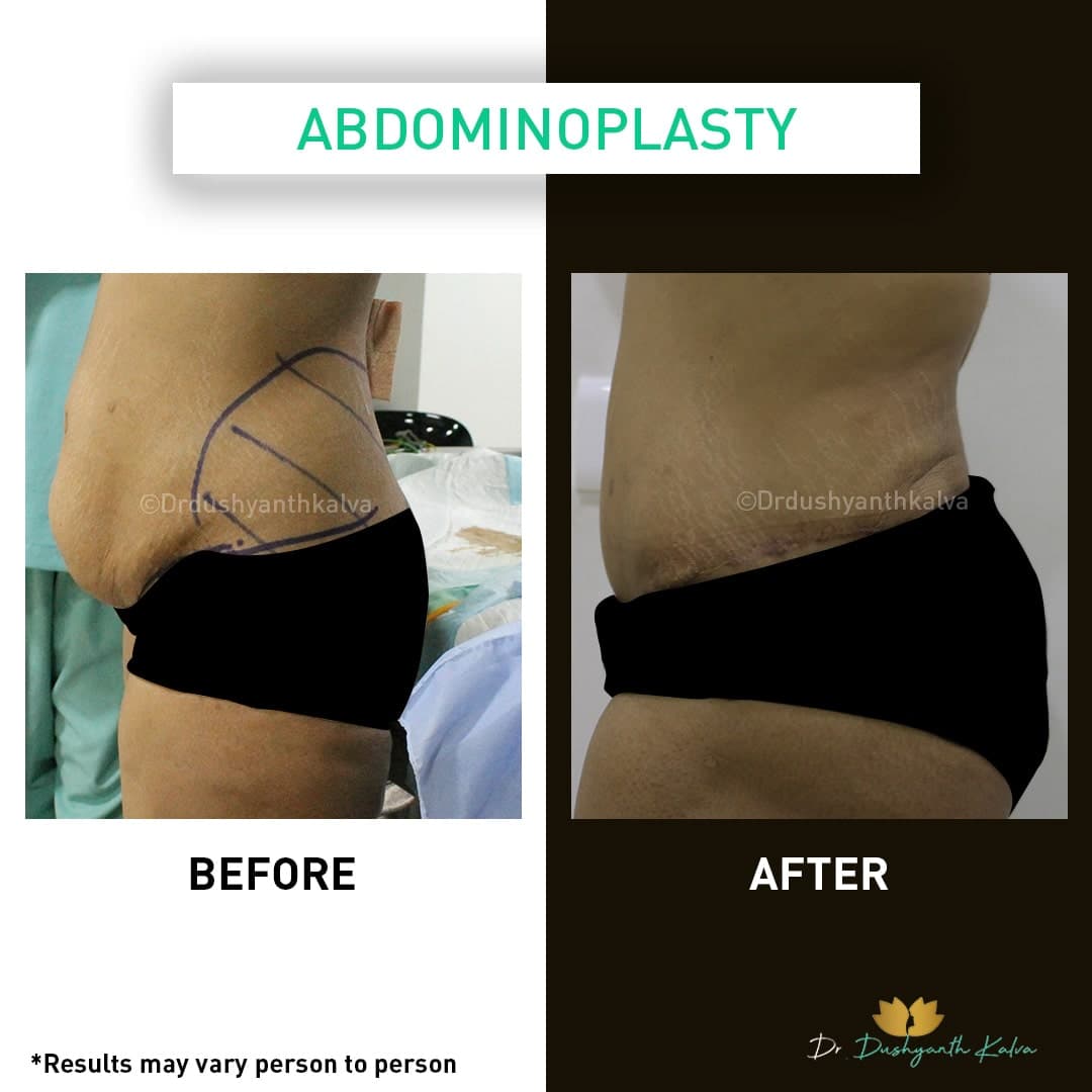Abdominoplasty before and after result 01