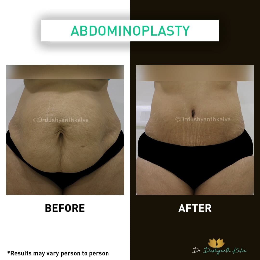 Abdominoplasty before and after result 04