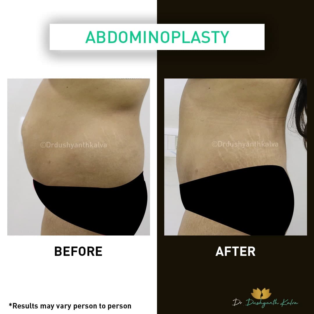 Abdominoplasty before and after result 07