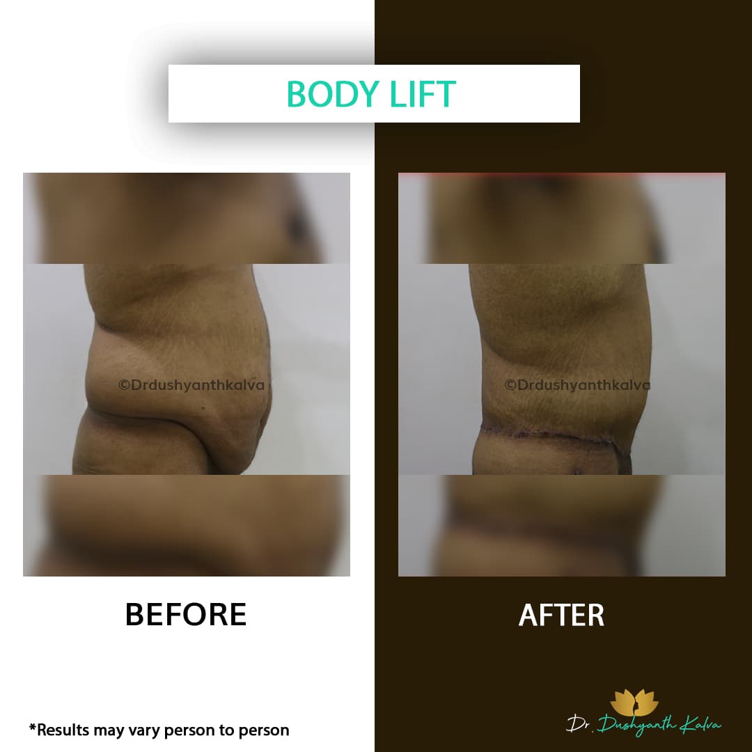 Abdominoplasty before and after result 08