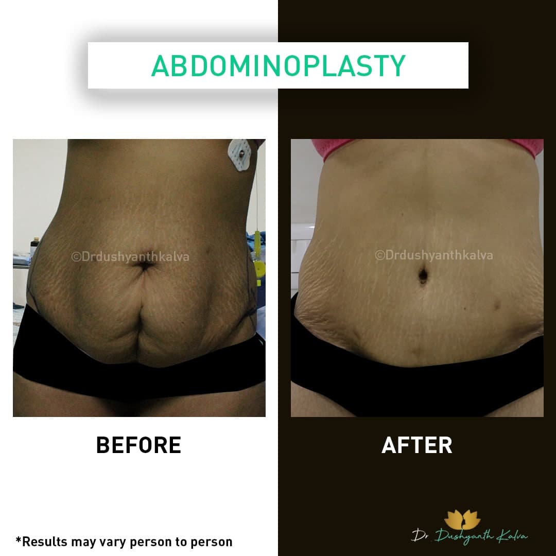 Abdominoplasty before and after result 02