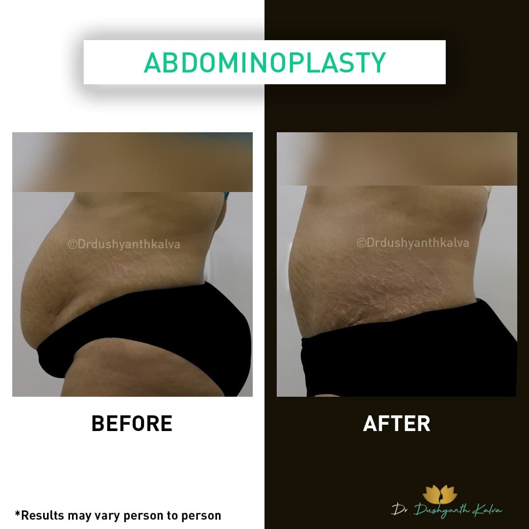Abdominoplasty before and after result 05