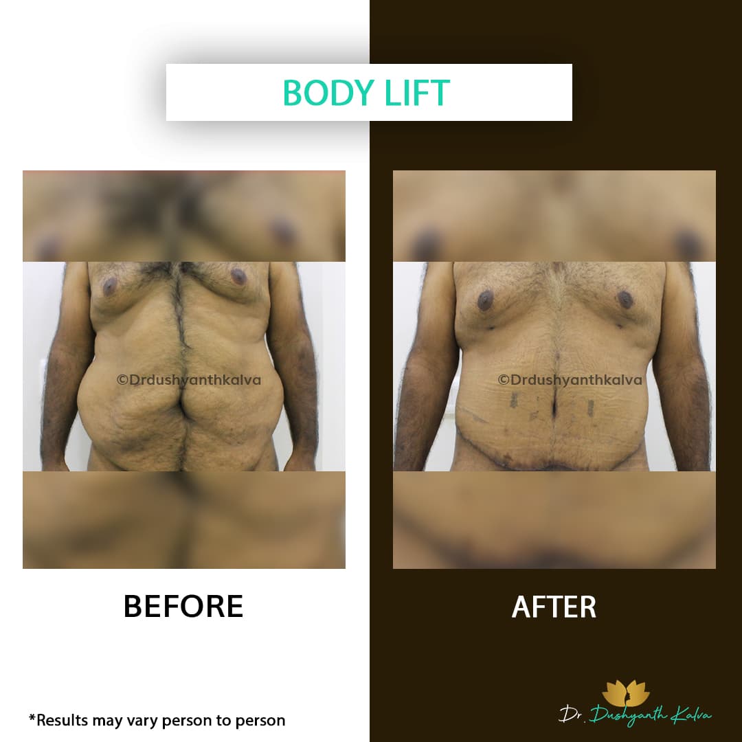 Abdominoplasty before and after result 09