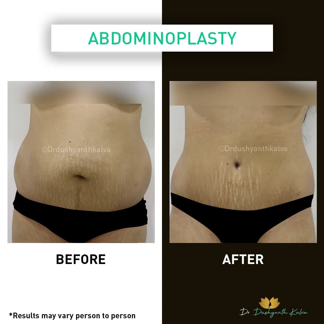 Abdominoplasty before and after result 10