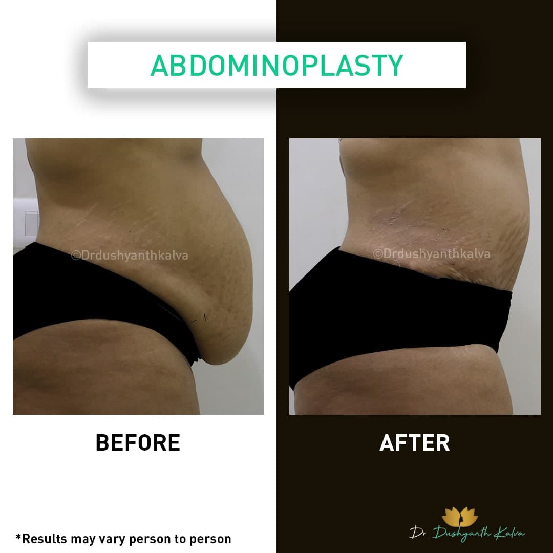 Abdominoplasty before and after result 03