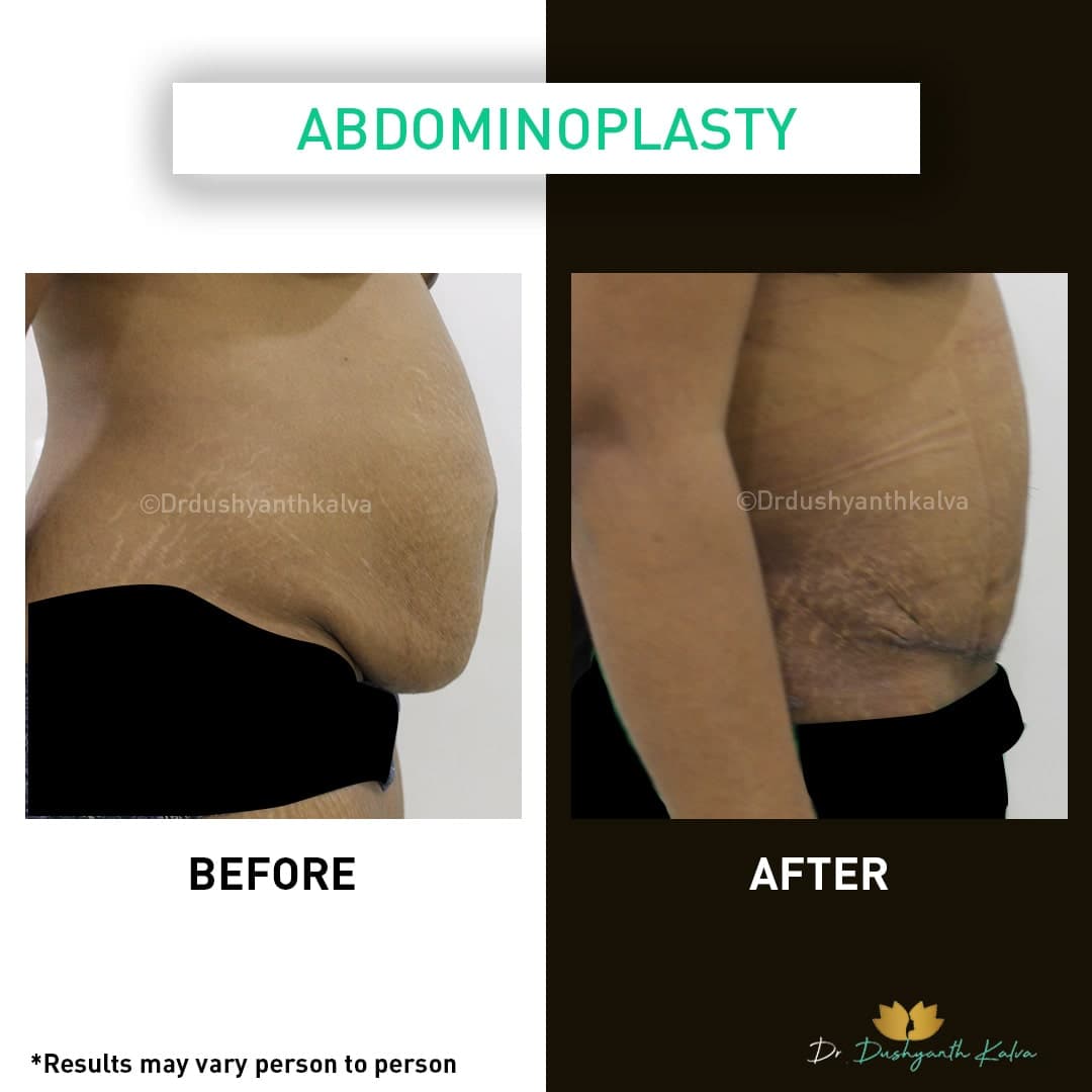 Abdominoplasty before and after result 06