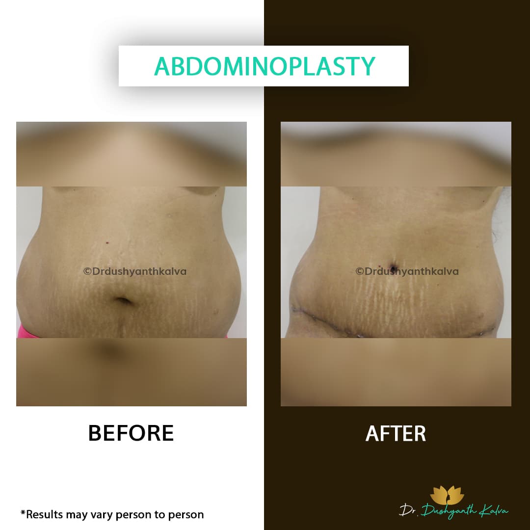 Abdominoplasty before and after result 11