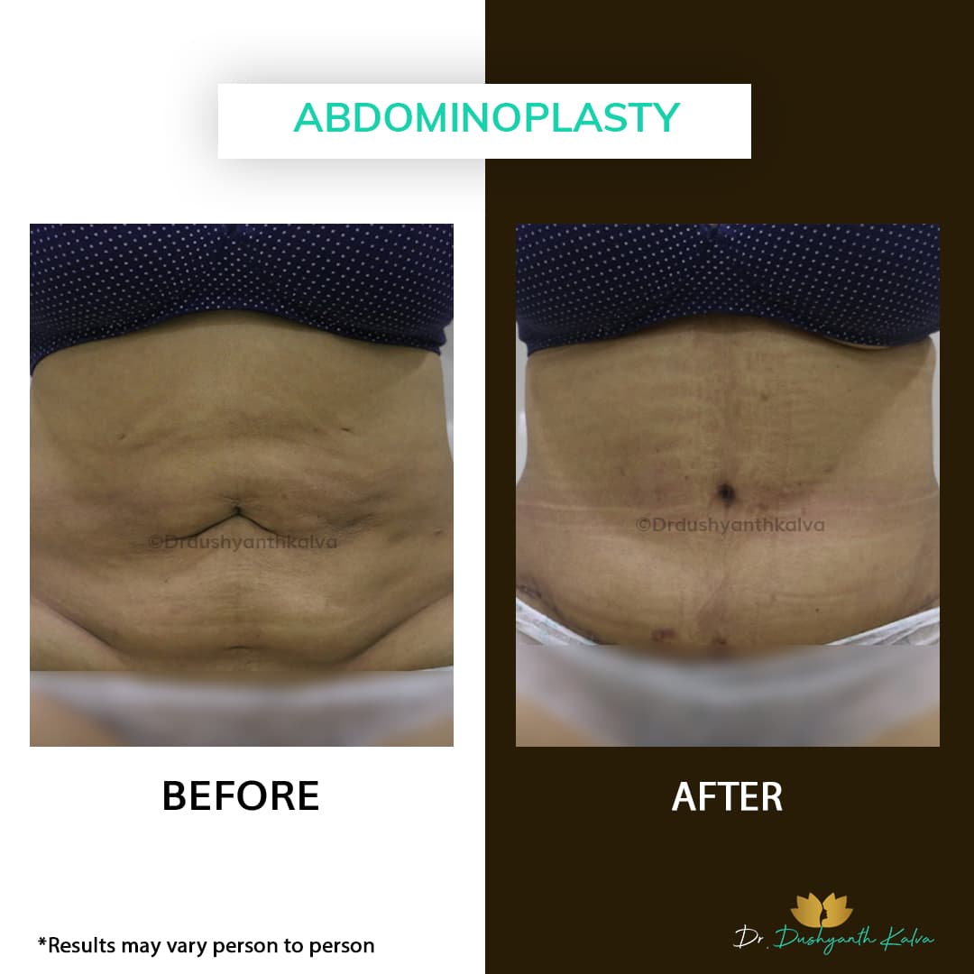 Abdominoplasty before and after result 12