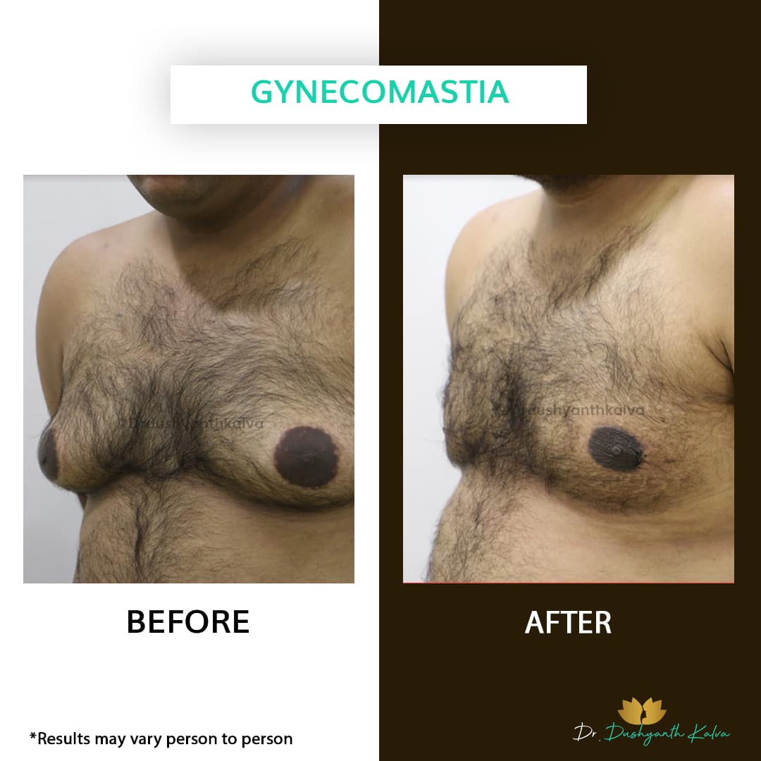 Gynecomastia before and after result 13