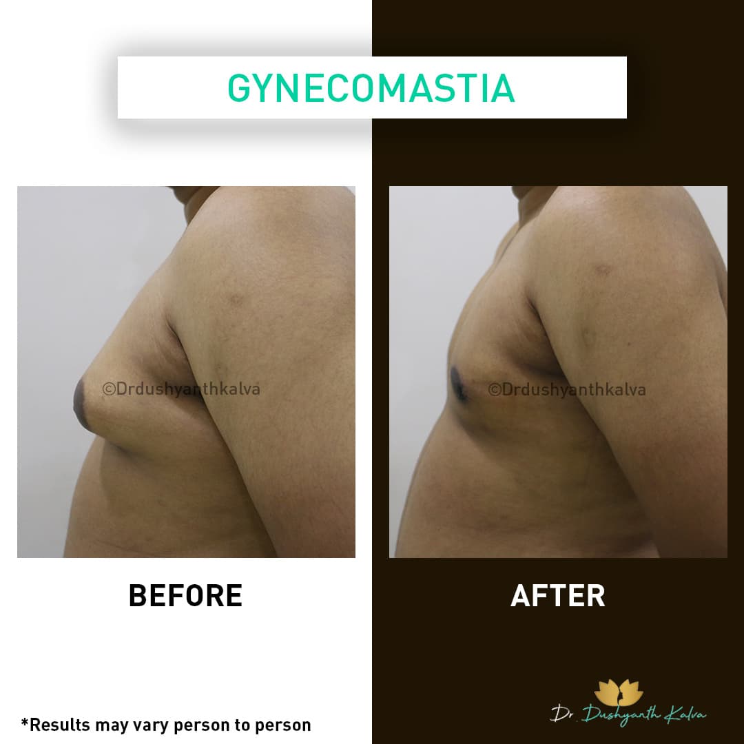 Gynecomastia before and after result 14
