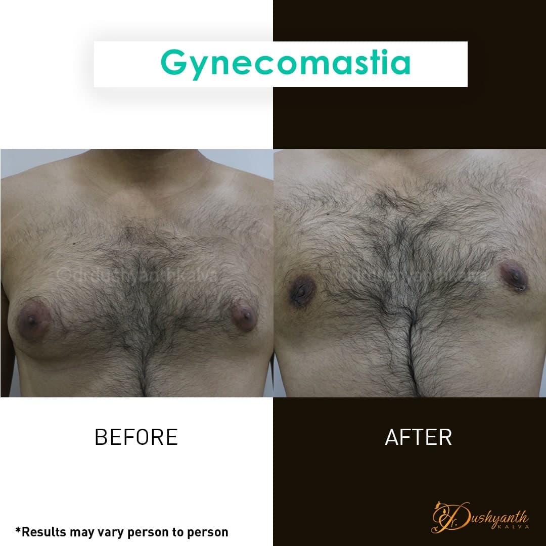 Gynecomastia before and after result 04
