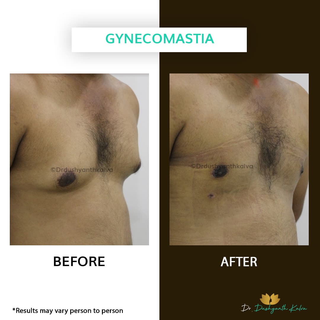 Gynecomastia before and after result 19