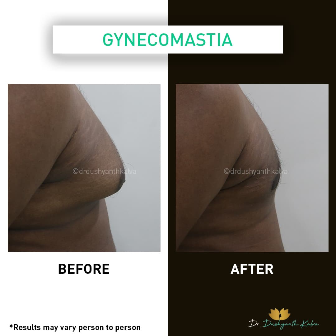 Gynecomastia before and after result 06