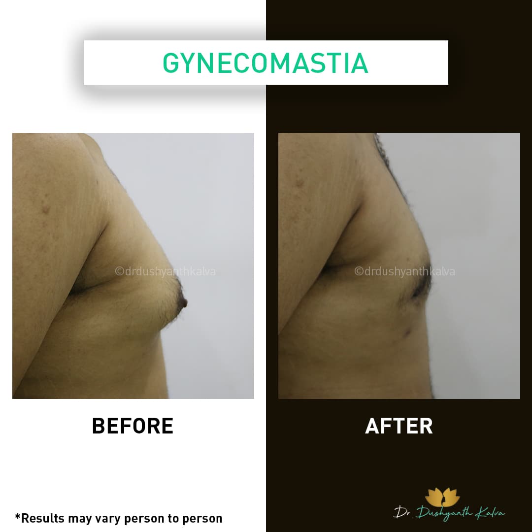 Gynecomastia before and after result 07