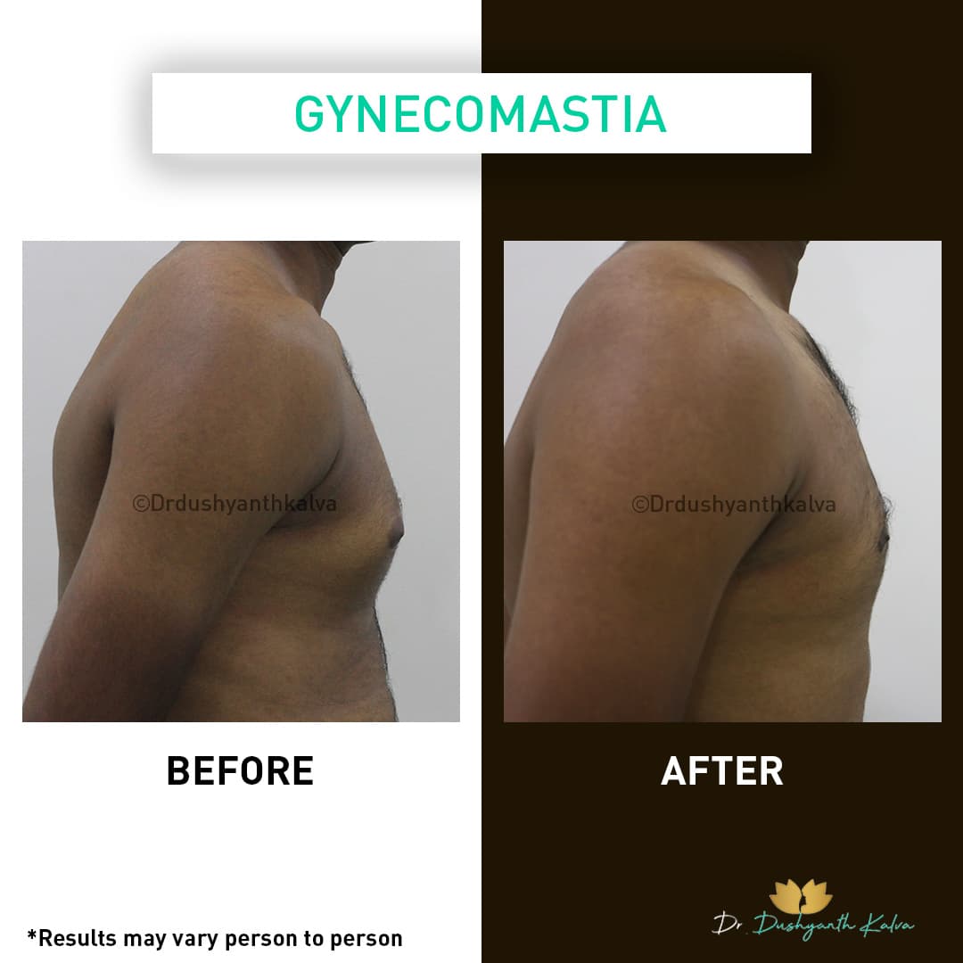 Gynecomastia before and after result 08