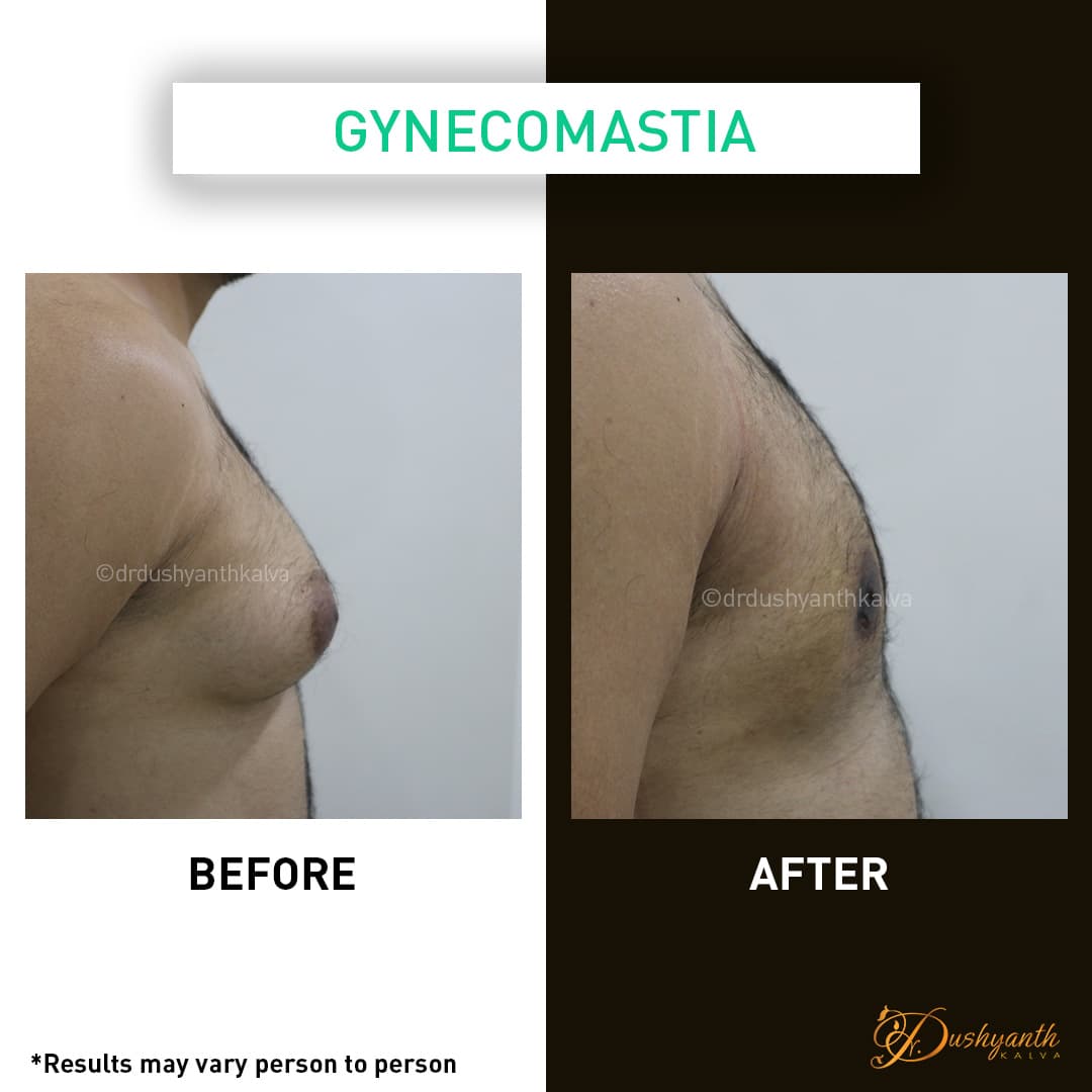 Gynecomastia before and after result 02