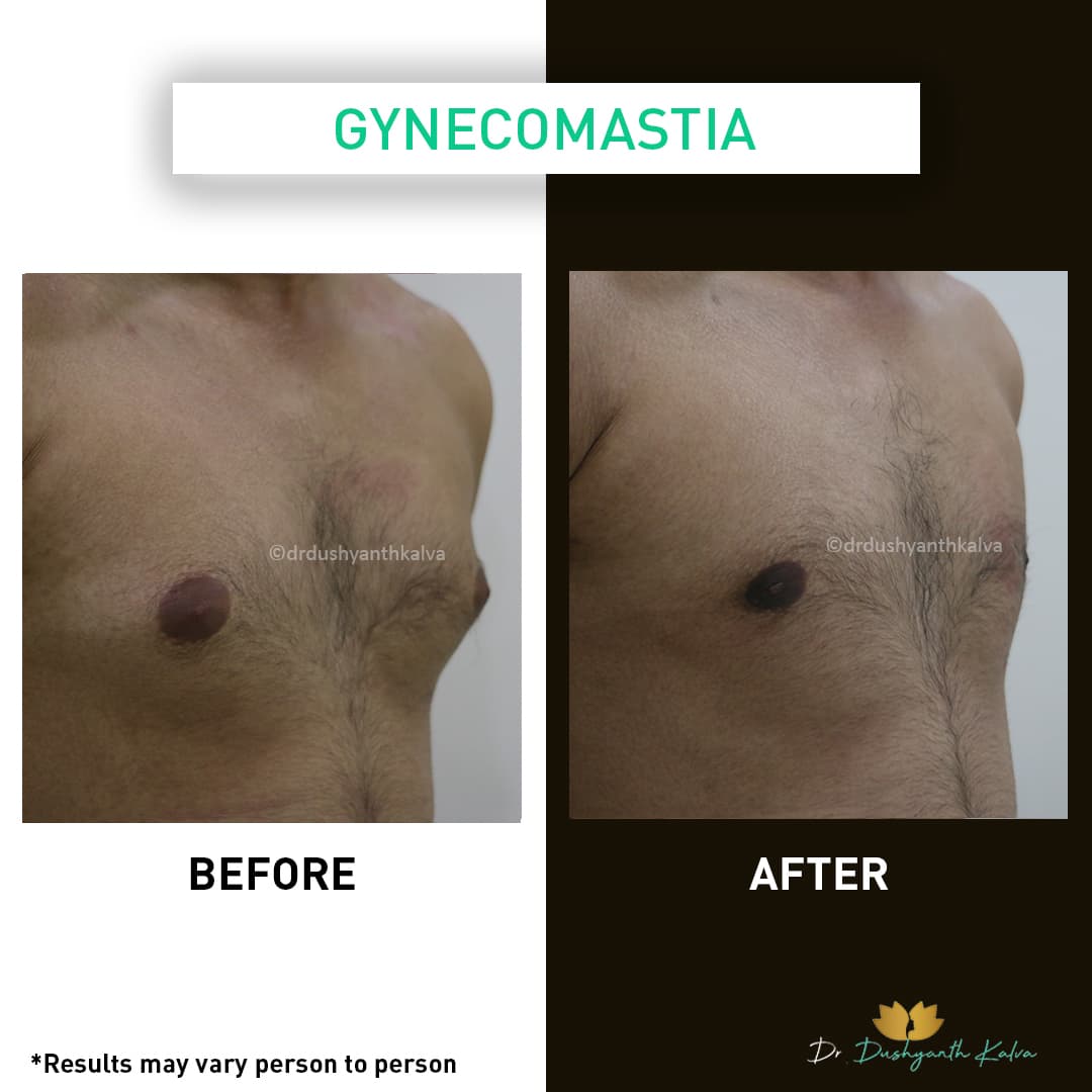 Gynecomastia before and after result 05