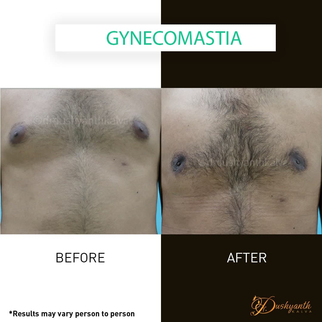 Gynecomastia before and after result 03