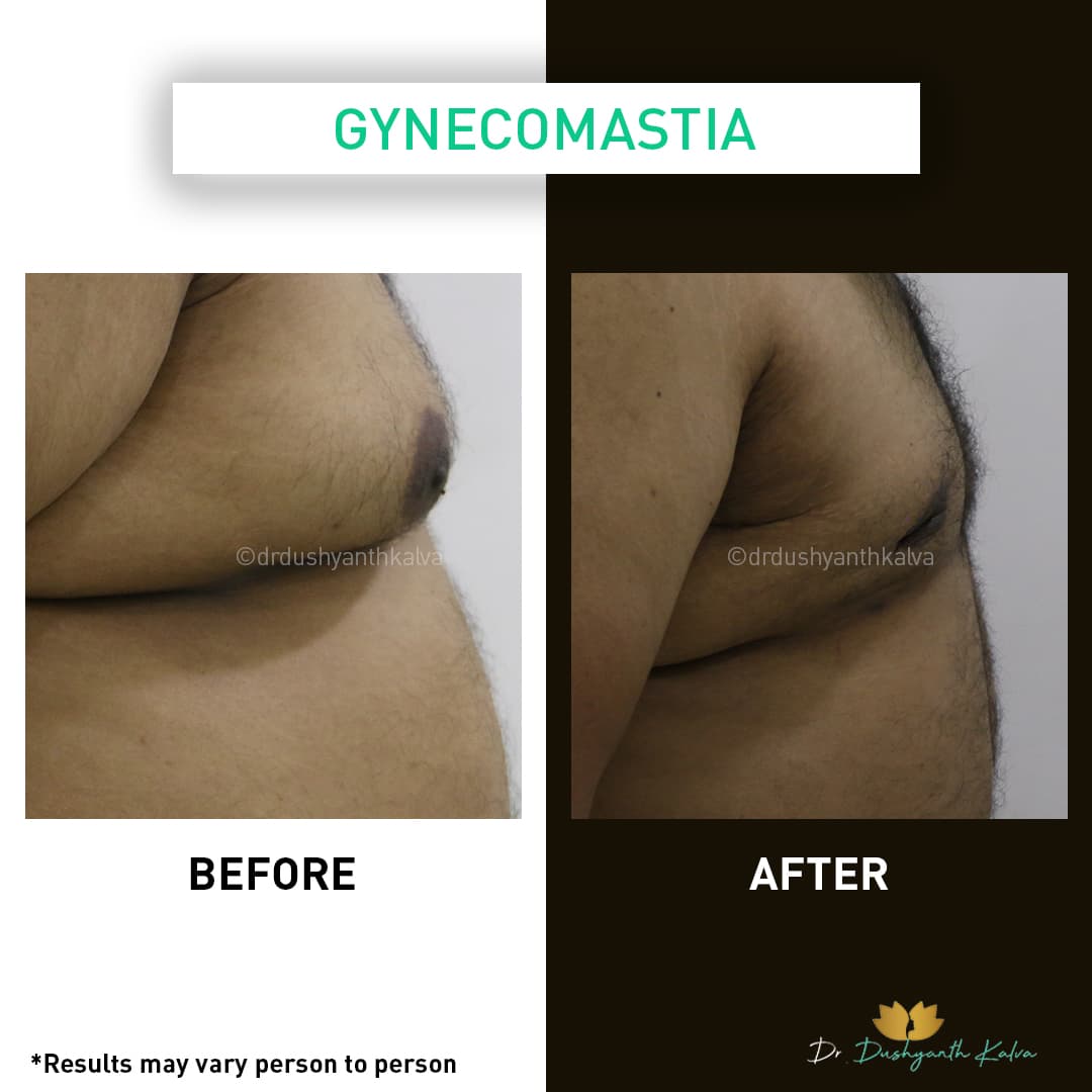 Gynecomastia before and after result 09