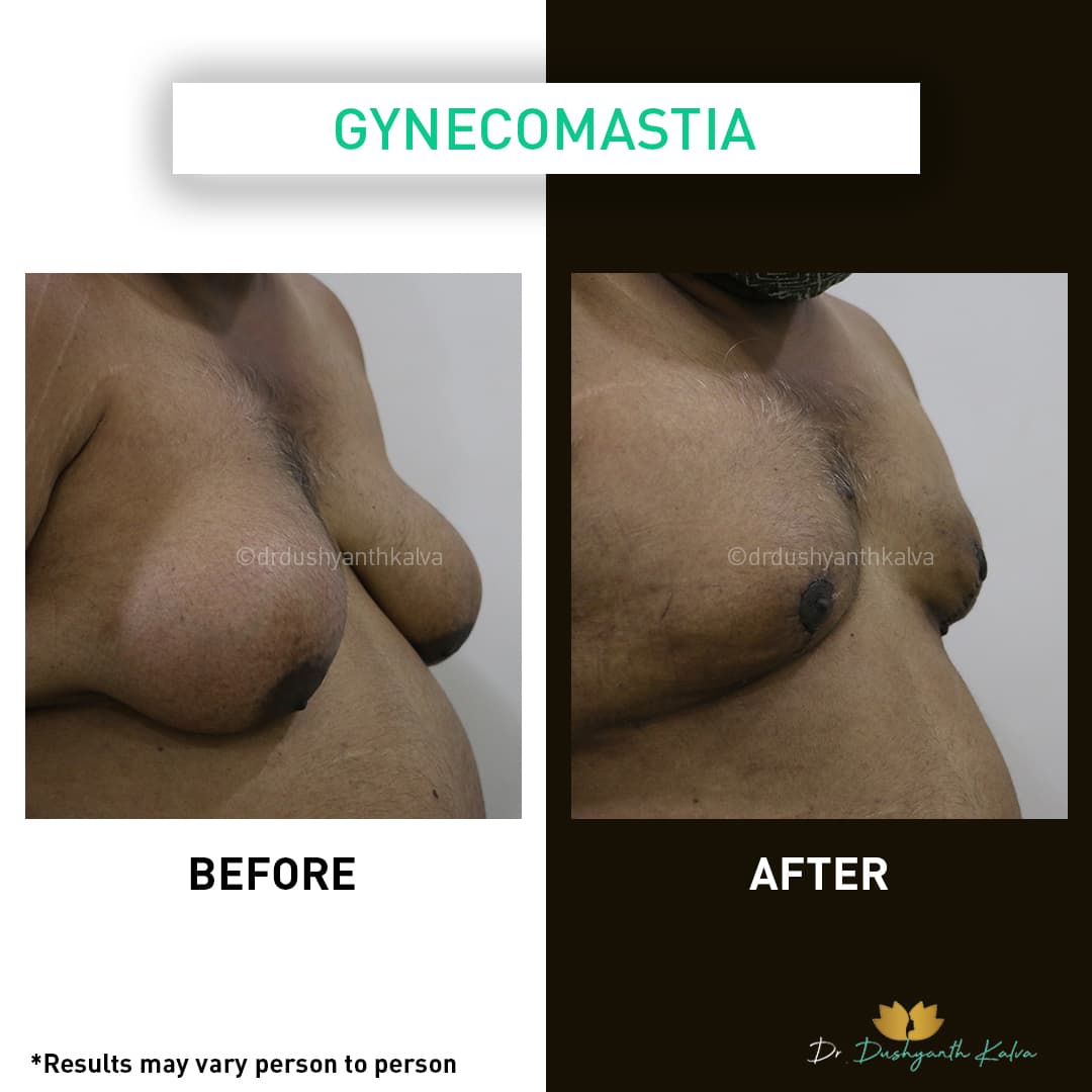 Gynecomastia before and after result 10