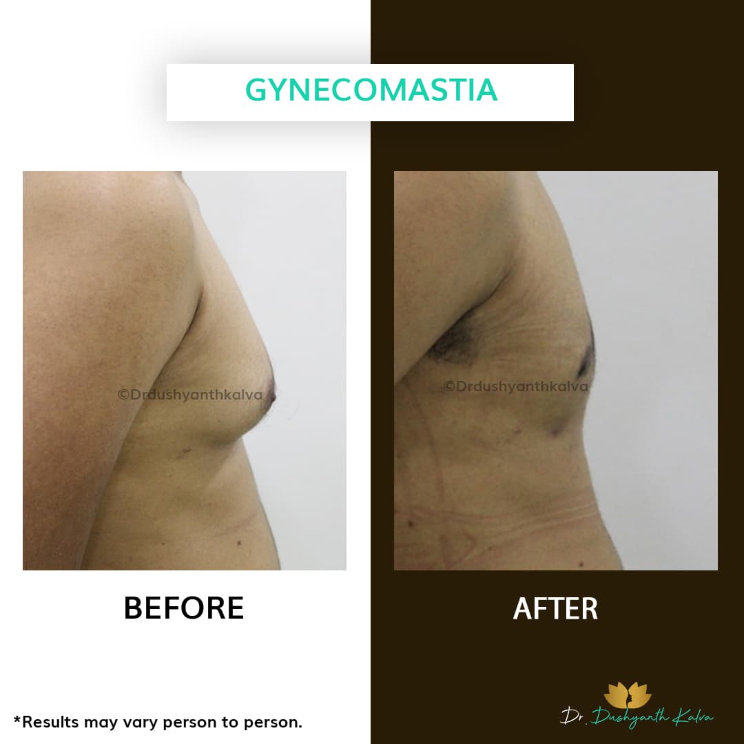 Gynecomastia before and after result 20