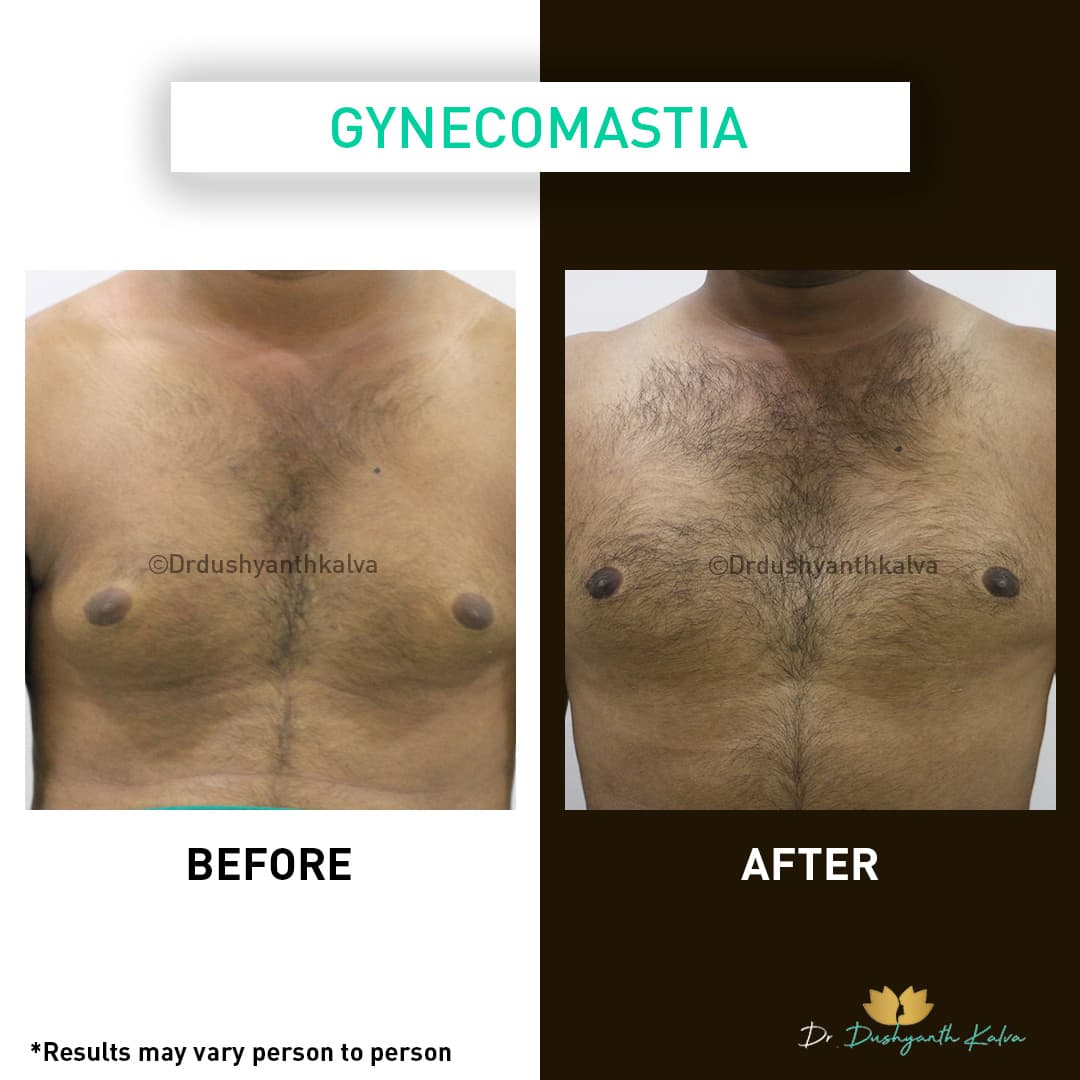 Gynecomastia before and after result 11