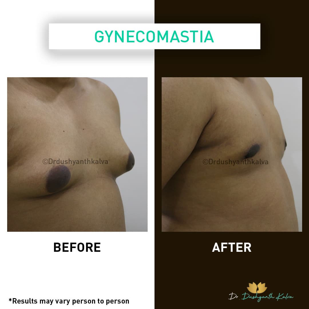 Gynecomastia before and after result 15