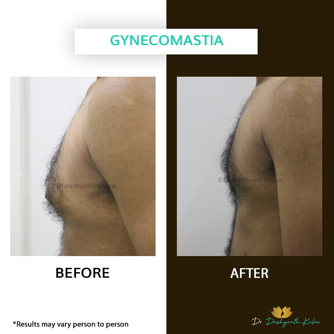 Gynecomastia before and after result 21