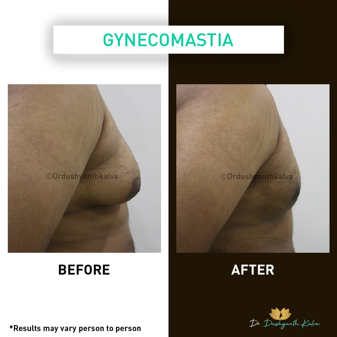 Gynecomastia before and after result 16