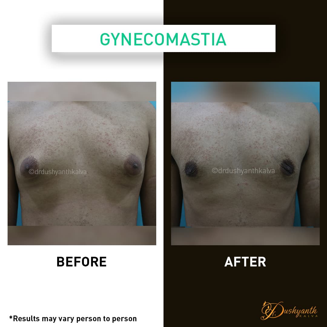 Gynecomastia before and after result 01