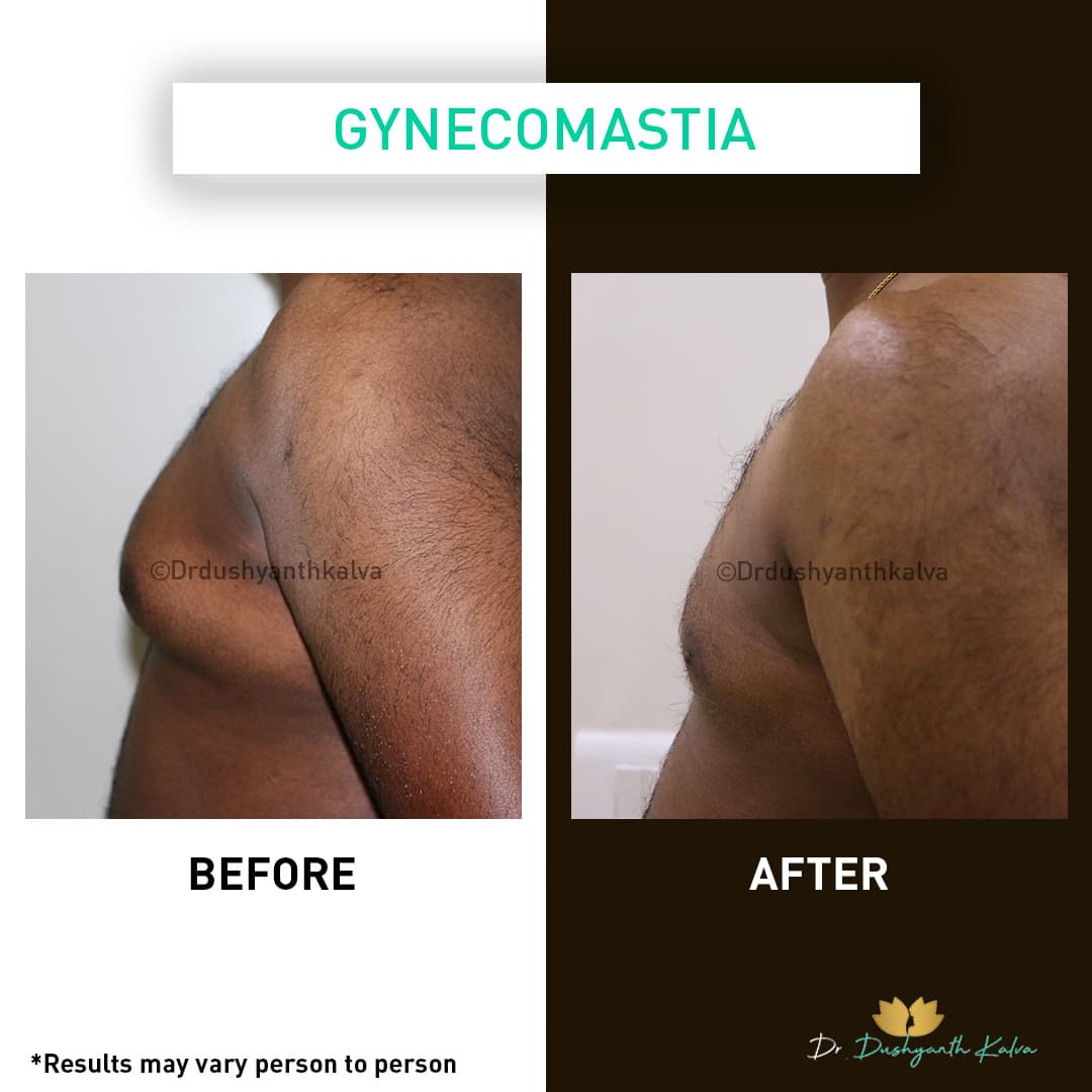 Gynecomastia before and after result 17