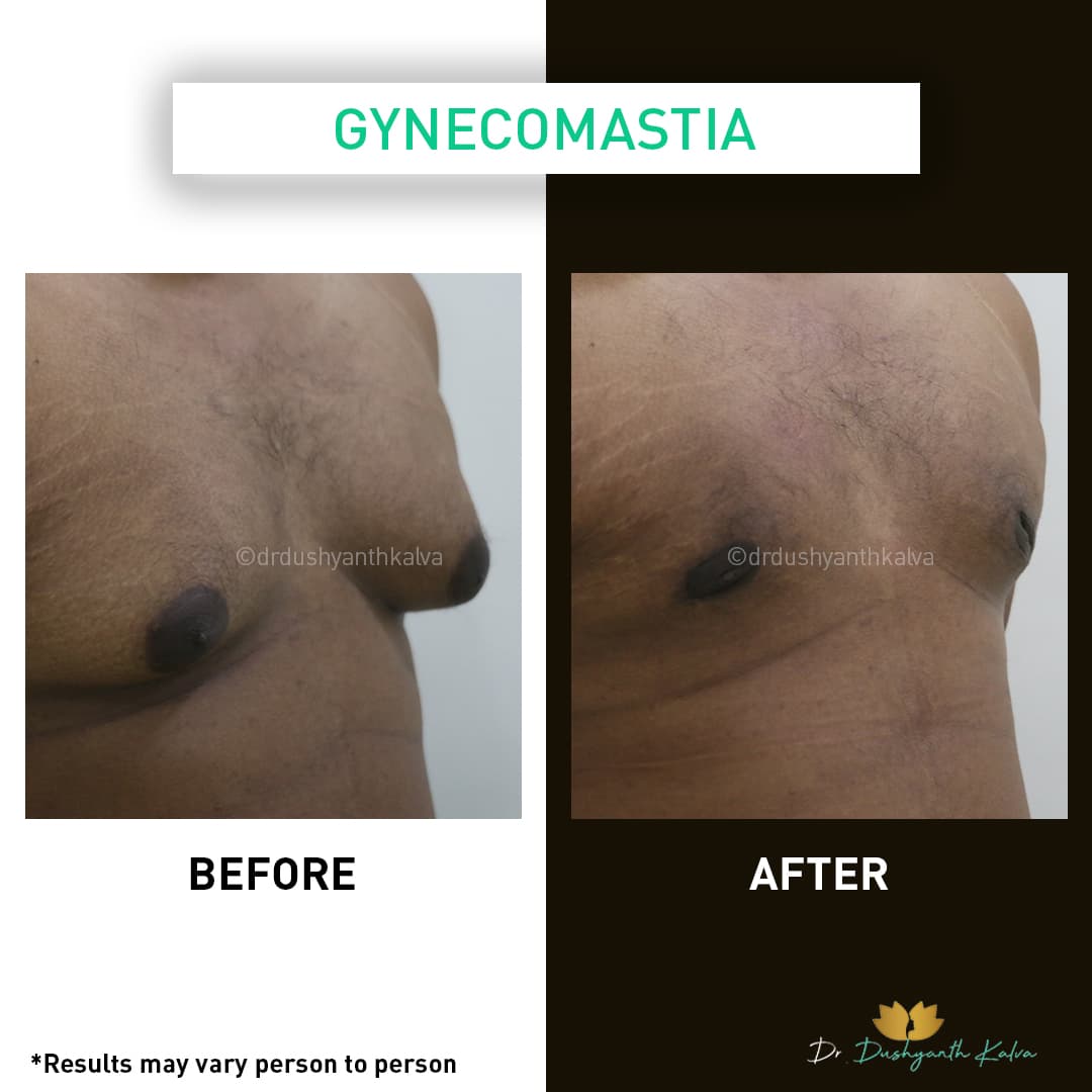 Gynecomastia before and after result 12