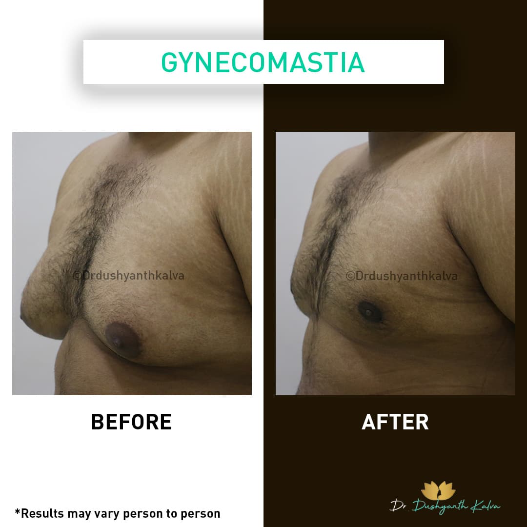 Gynecomastia before and after result 18