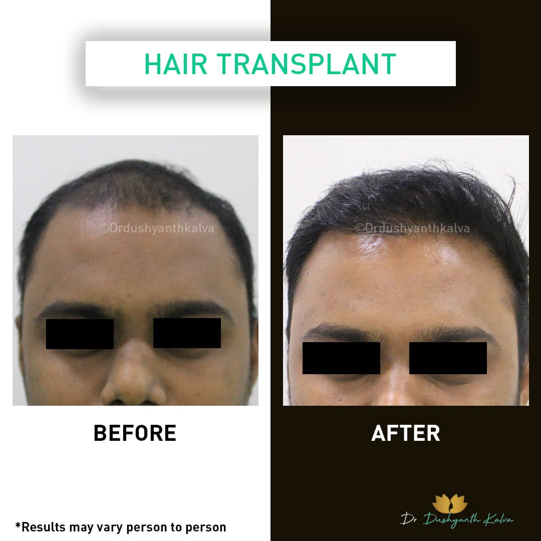 Hair transplant before and after result 06
