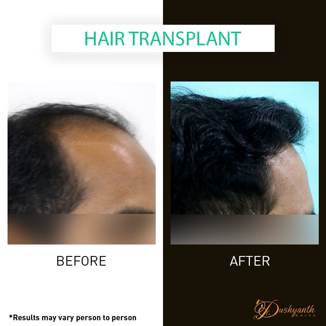 Hair transplant before and after result 04