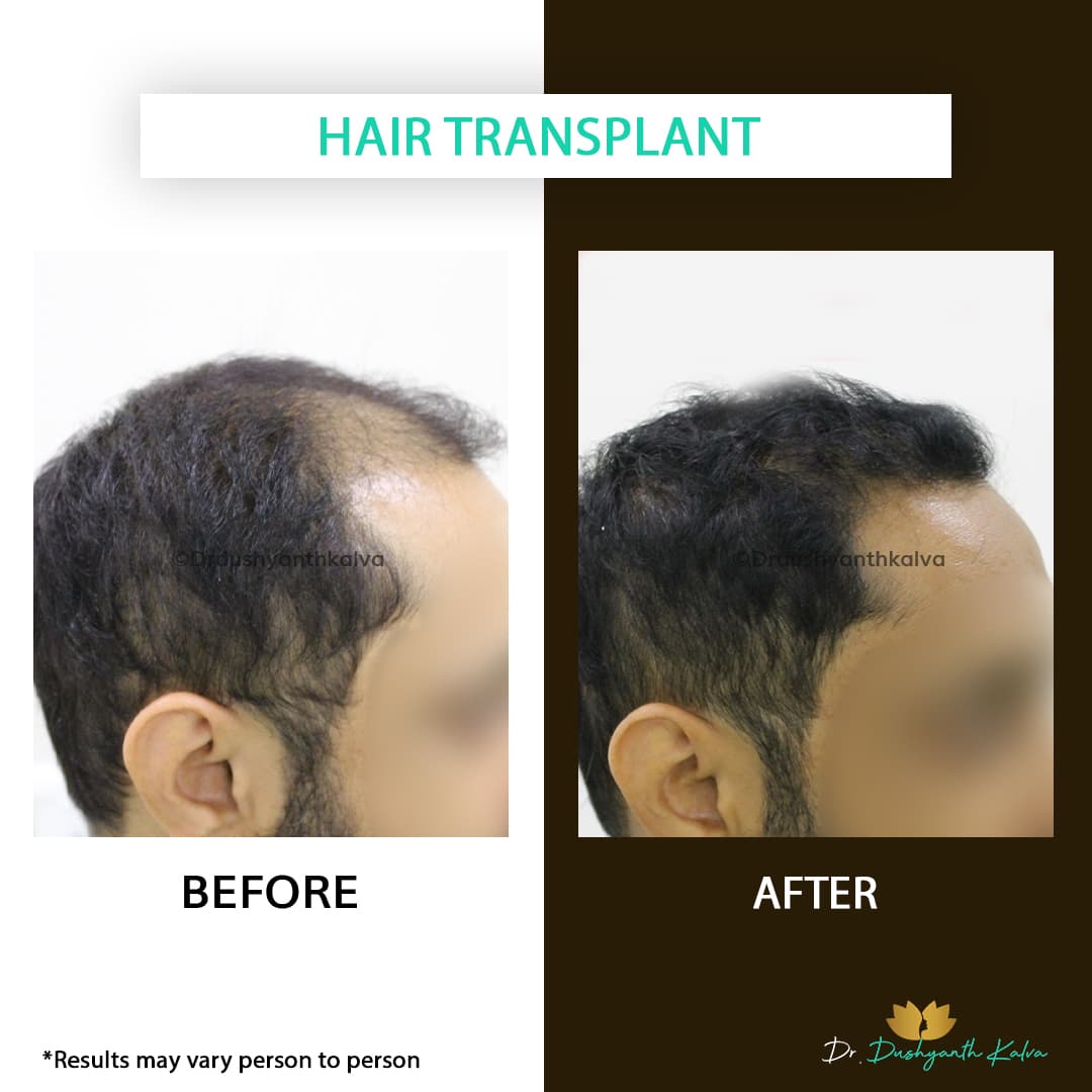Hair transplant before and after result 18