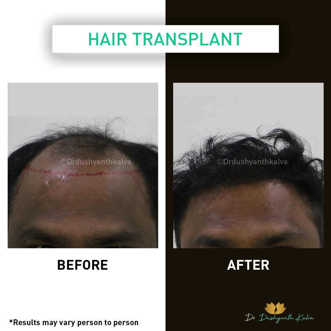 Hair transplant before and after result 12