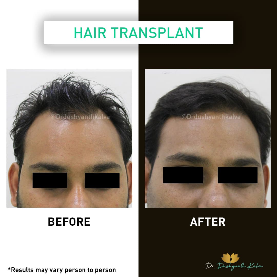 Hair transplant before and after result 09