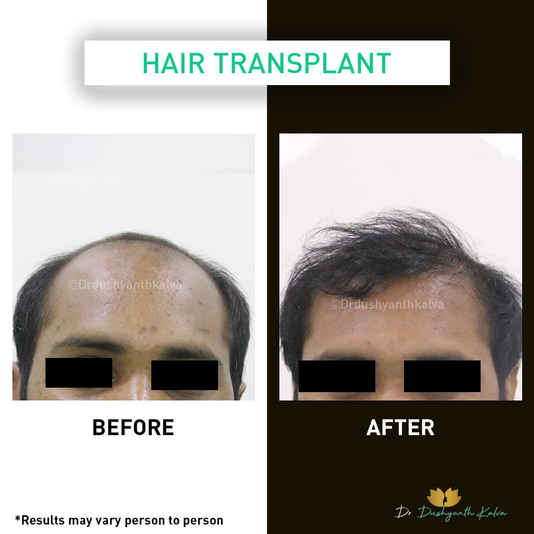 Hair transplant before and after result 07