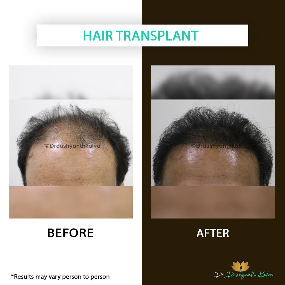 Hair transplant before and after result 20