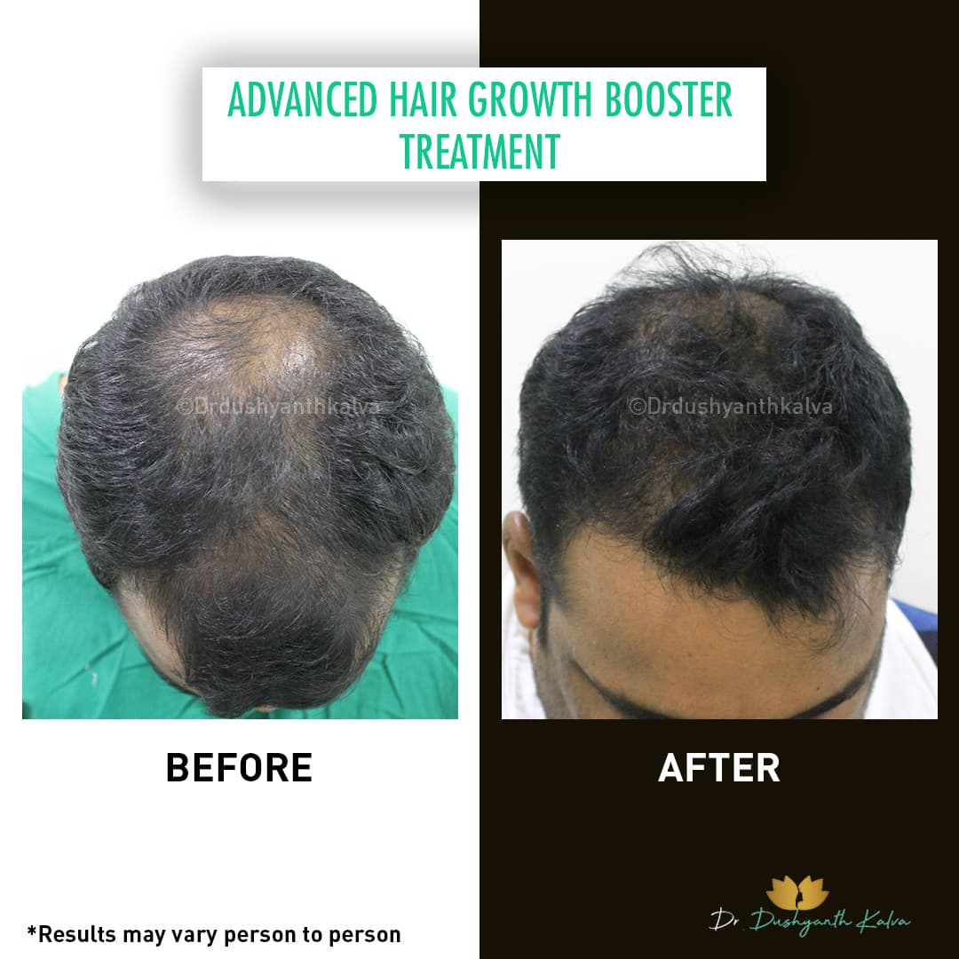 Hair transplant before and after result 05