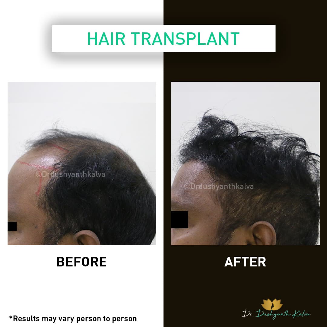 Hair transplant before and after result 10