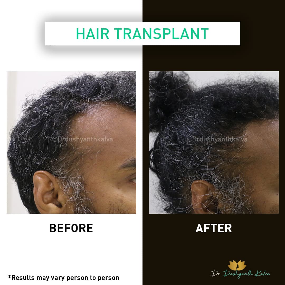 Hair transplant before and after result 13