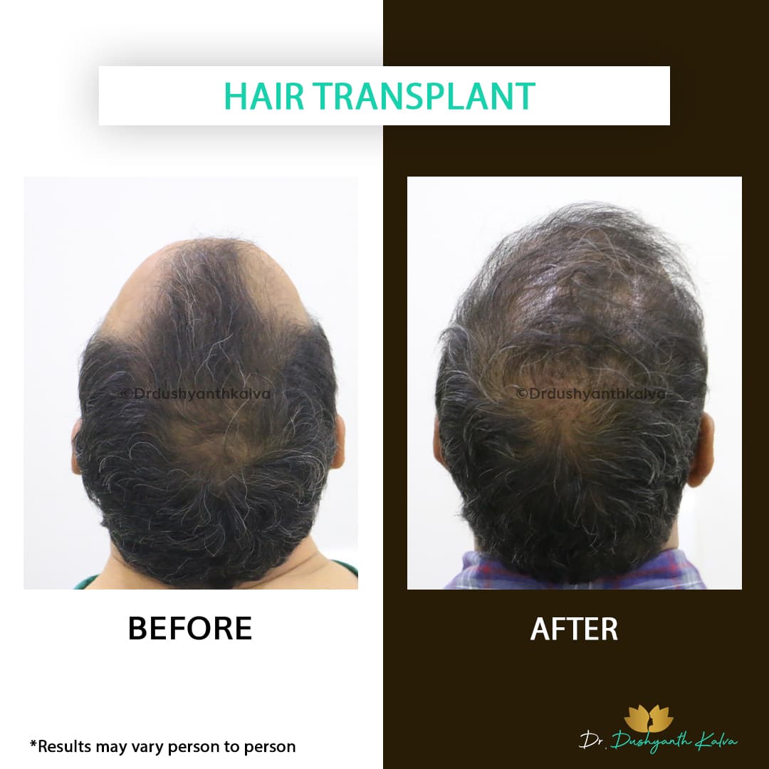 Hair transplant before and after result 17