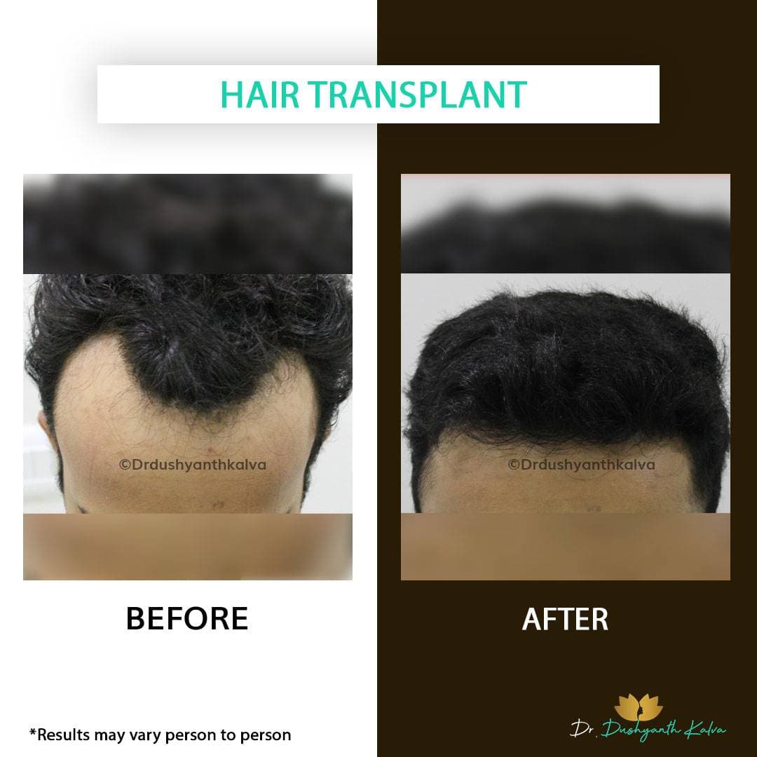Hair transplant before and after result 16