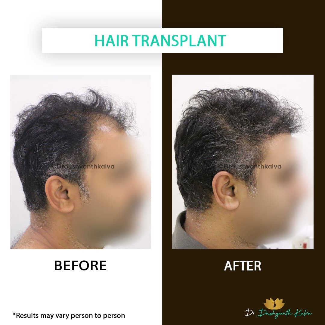 Hair transplant before and after result 19