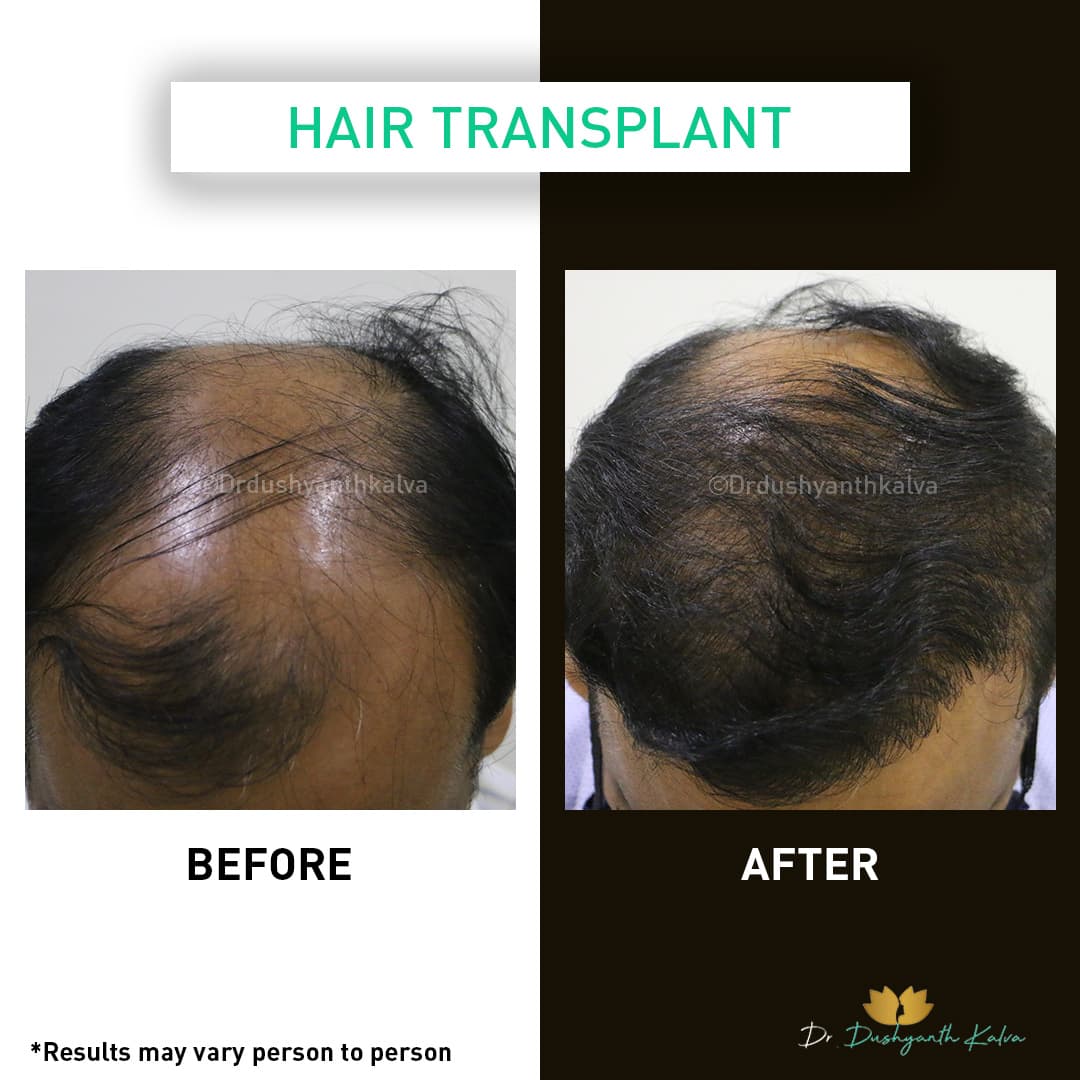 Hair transplant before and after result 15