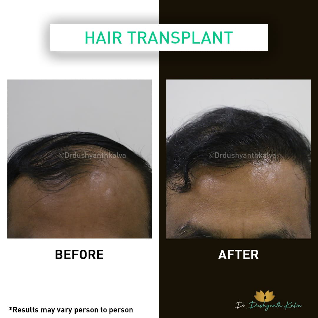 Hair transplant before and after result 14