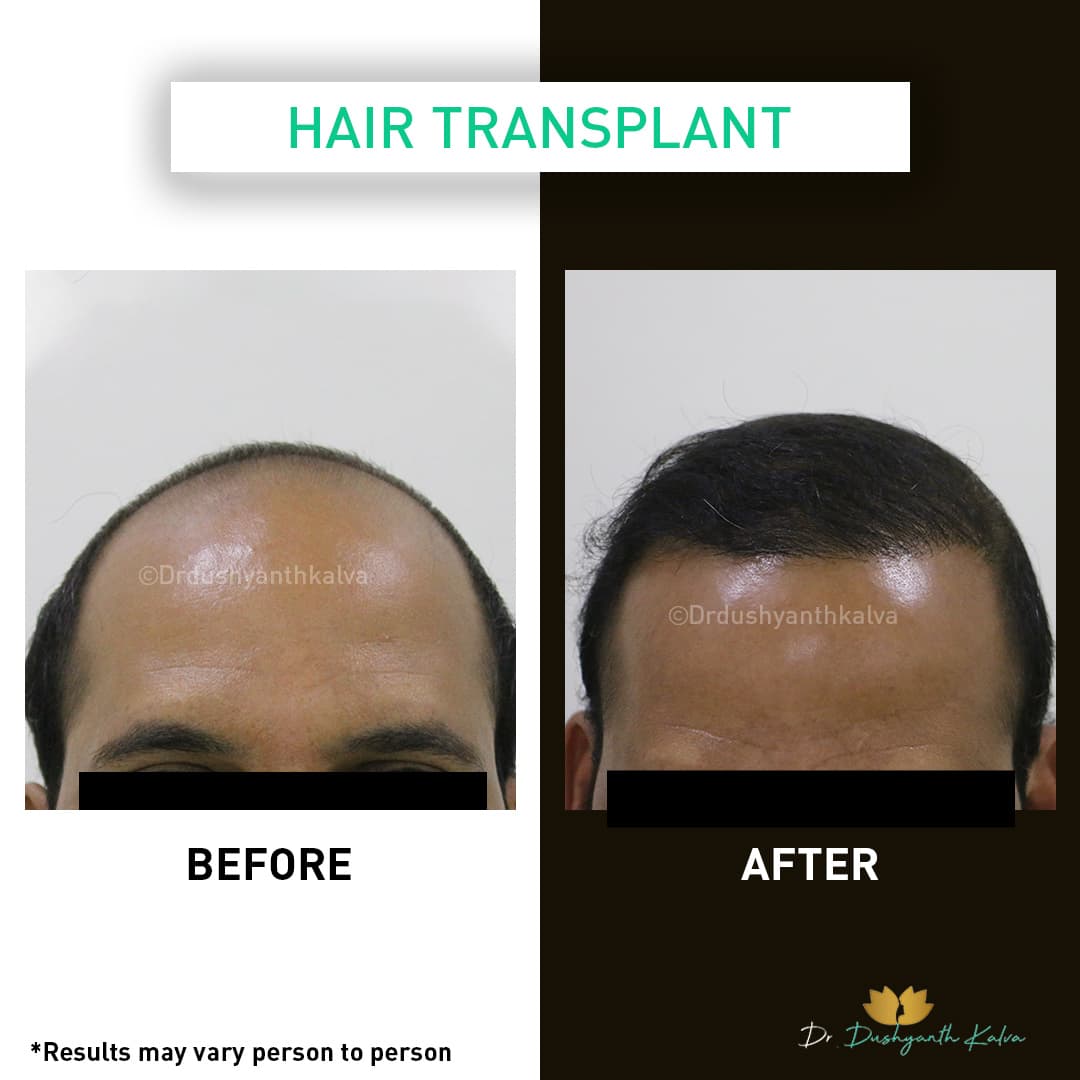 Hair transplant before and after result 08