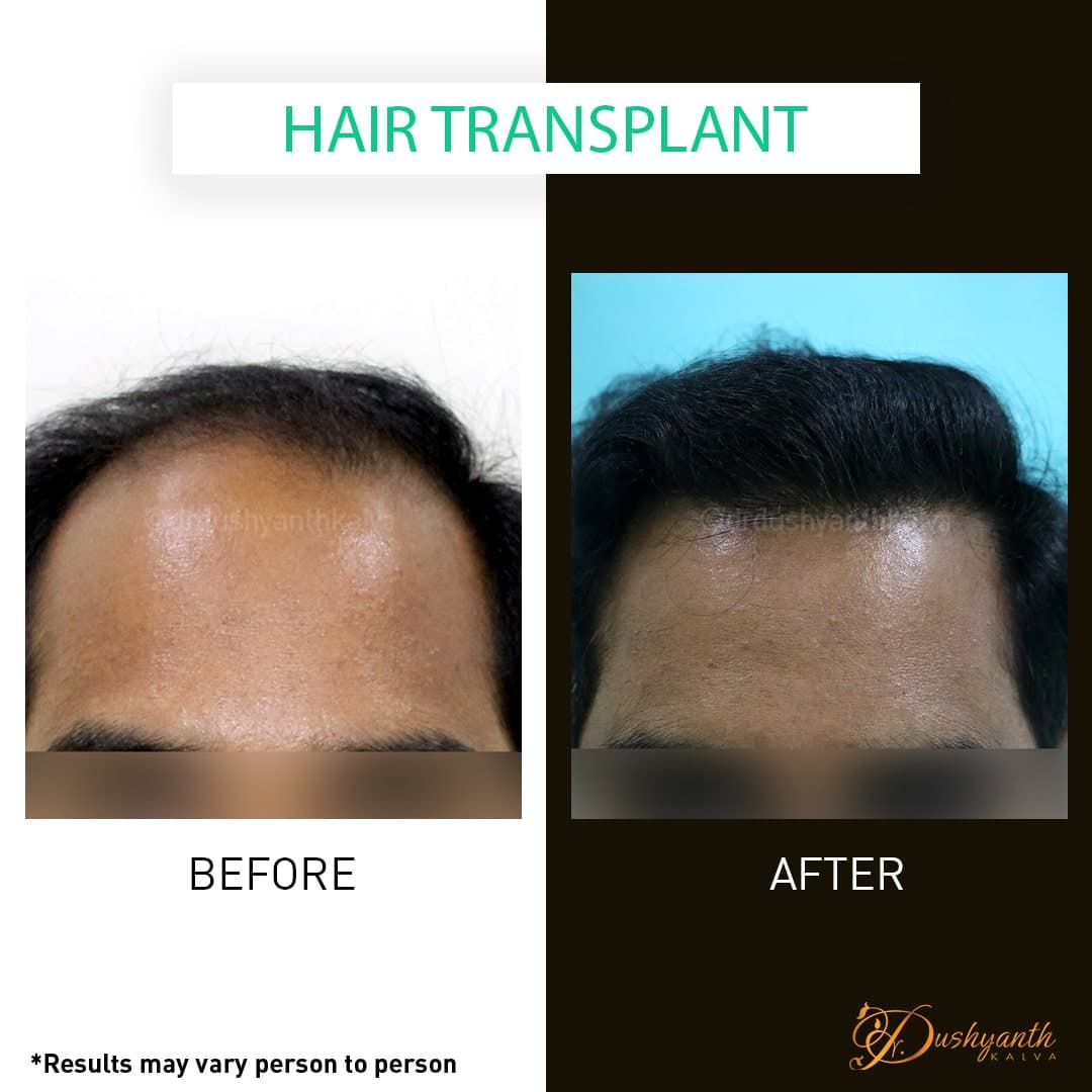 Hair transplant before and after result 03